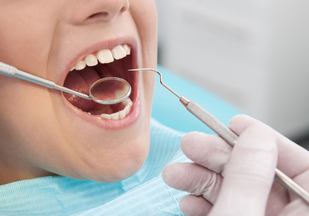dental fillings in langley