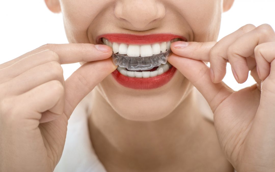 Invisalign: An Innovative Solution for a Straighter Smile