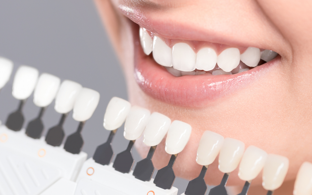 Cost of Porcelain Veneers in Langley