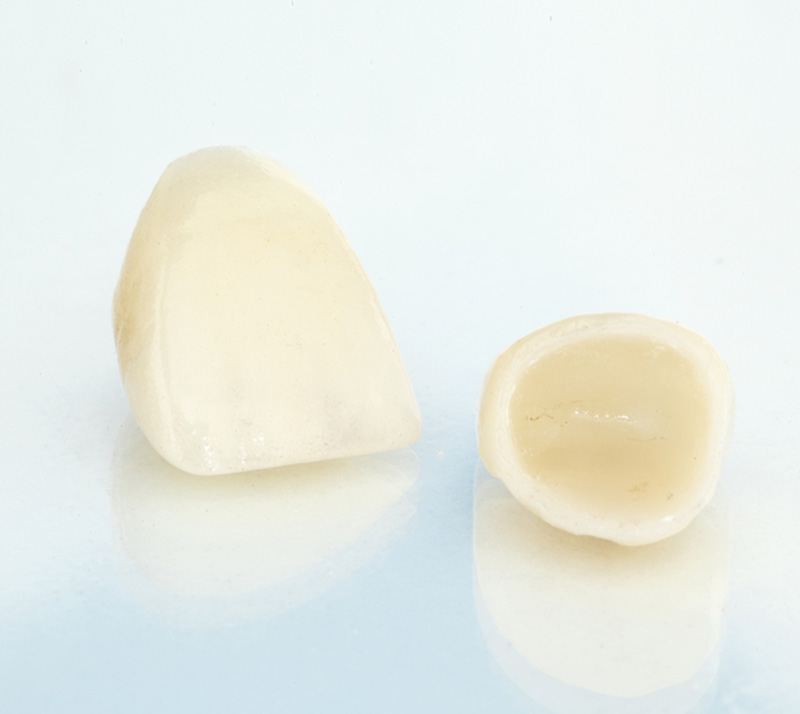 Dental crown & veneer restoration close-up